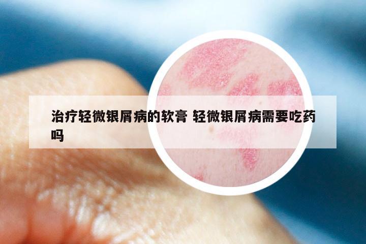 治疗轻微银屑病的软膏 轻微银屑病需要吃药吗
