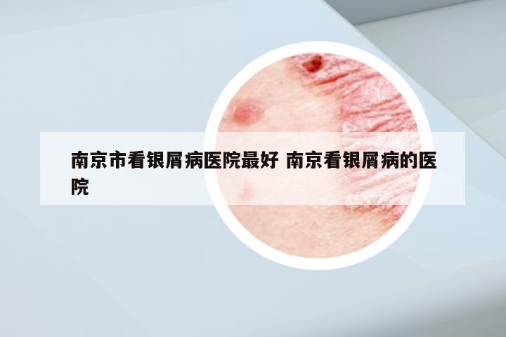 南京市看银屑病医院最好 南京看银屑病的医院