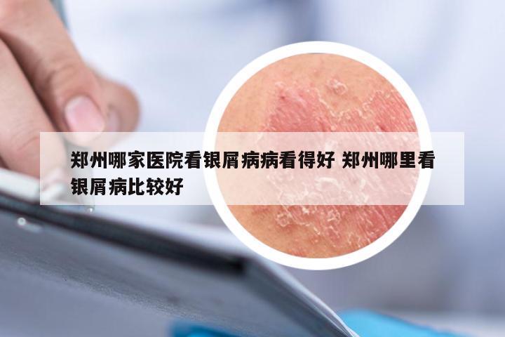 郑州哪家医院看银屑病病看得好 郑州哪里看银屑病比较好