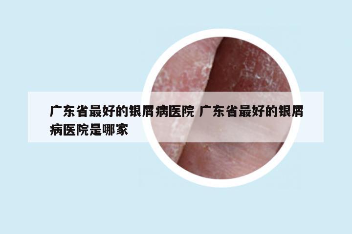 广东省最好的银屑病医院 广东省最好的银屑病医院是哪家