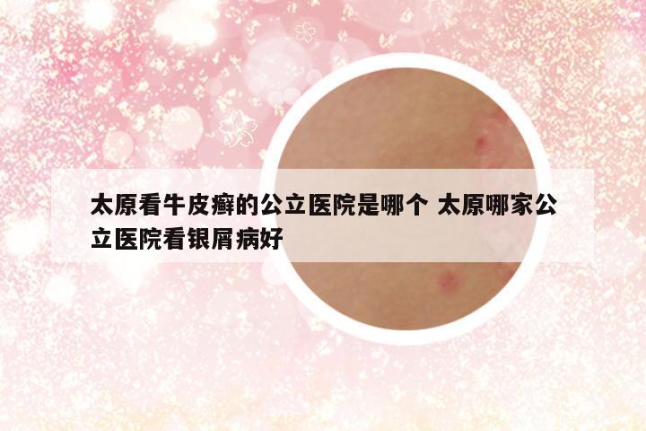 太原看牛皮癣的公立医院是哪个 太原哪家公立医院看银屑病好