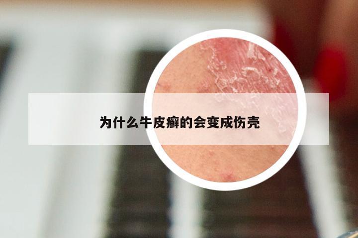 为什么牛皮癣的会变成伤壳