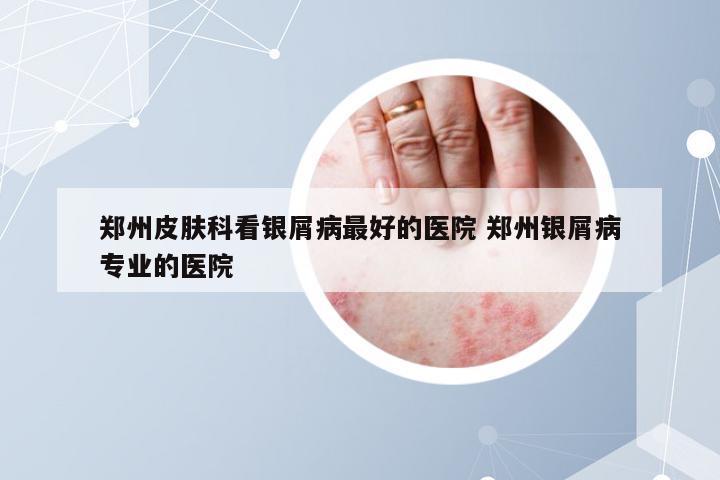 郑州皮肤科看银屑病最好的医院 郑州银屑病专业的医院