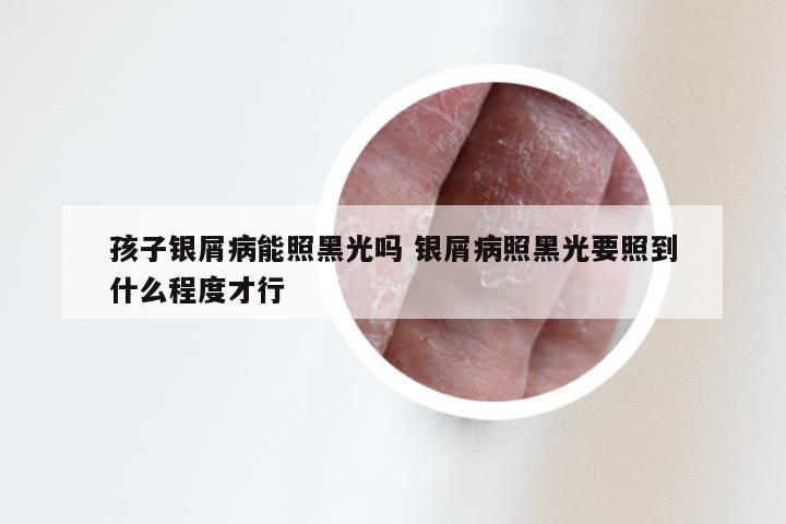 孩子银屑病能照黑光吗 银屑病照黑光要照到什么程度才行