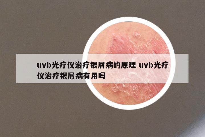 uvb光疗仪治疗银屑病的原理 uvb光疗仪治疗银屑病有用吗