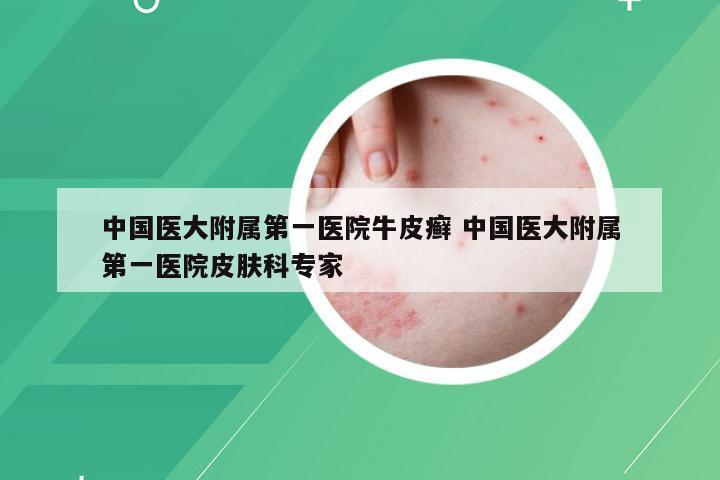 中国医大附属第一医院牛皮癣 中国医大附属第一医院皮肤科专家