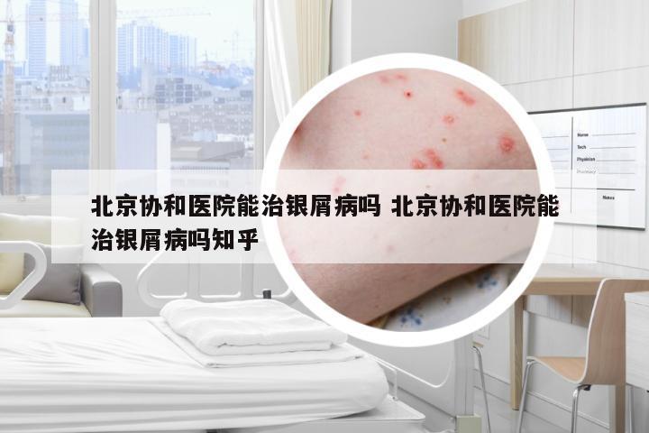 北京协和医院能治银屑病吗 北京协和医院能治银屑病吗知乎