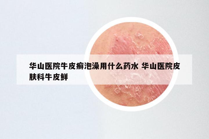 华山医院牛皮癣泡澡用什么药水 华山医院皮肤科牛皮鲜
