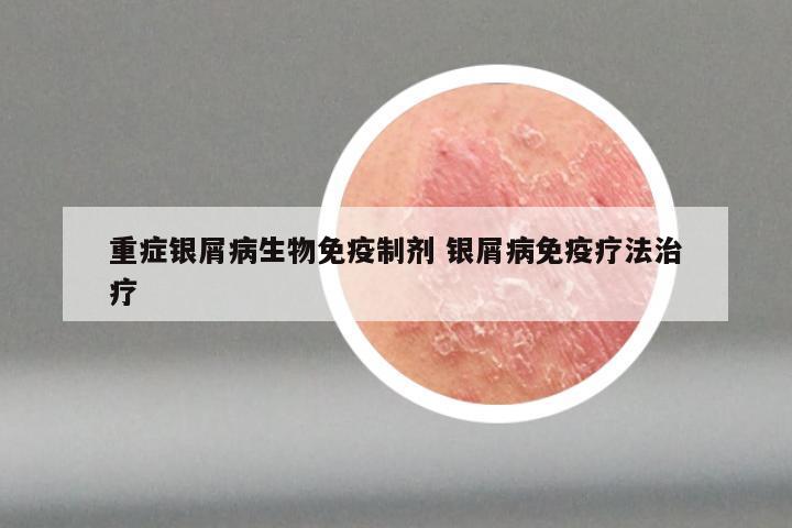 重症银屑病生物免疫制剂 银屑病免疫疗法治疗