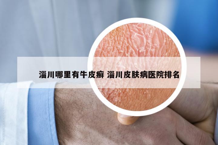 淄川哪里有牛皮癣 淄川皮肤病医院排名