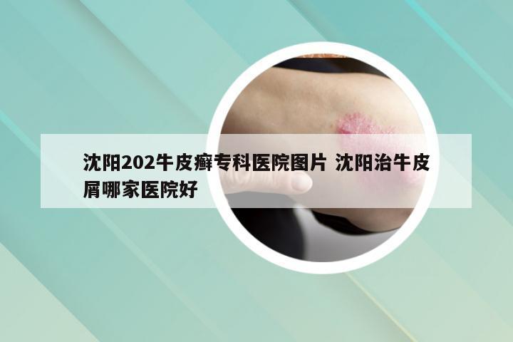 沈阳202牛皮癣专科医院图片 沈阳治牛皮屑哪家医院好