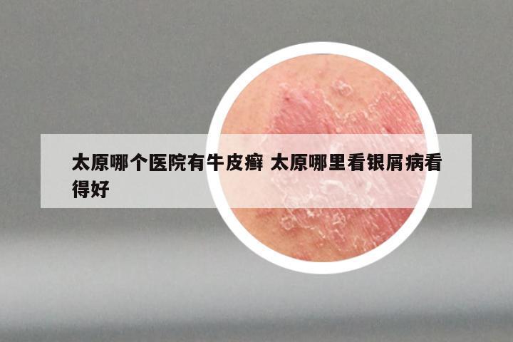 太原哪个医院有牛皮癣 太原哪里看银屑病看得好