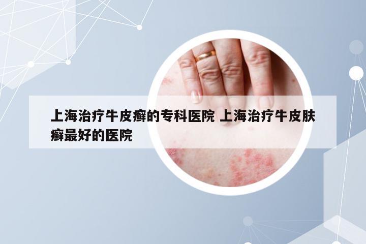 上海治疗牛皮癣的专科医院 上海治疗牛皮肤癣最好的医院