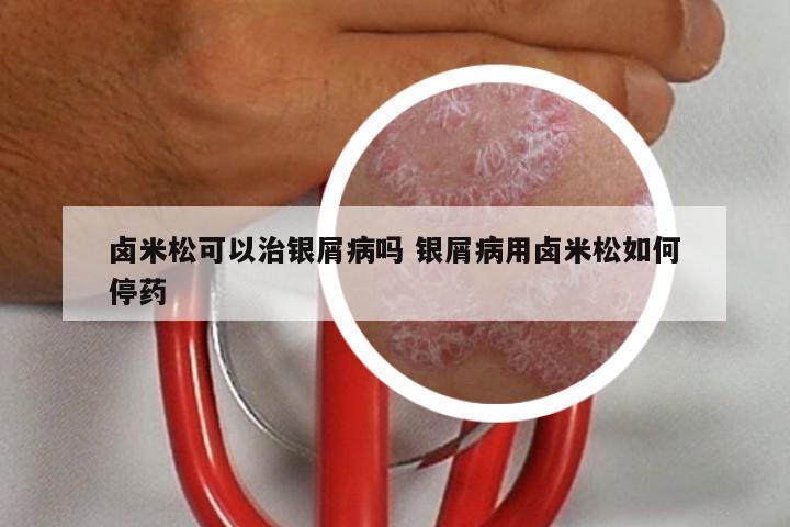 卤米松可以治银屑病吗 银屑病用卤米松如何停药