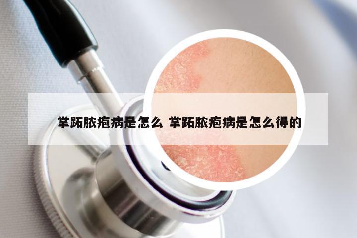 掌跖脓疱病是怎么 掌跖脓疱病是怎么得的