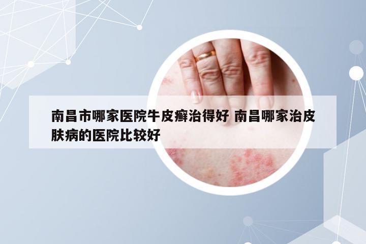 南昌市哪家医院牛皮癣治得好 南昌哪家治皮肤病的医院比较好