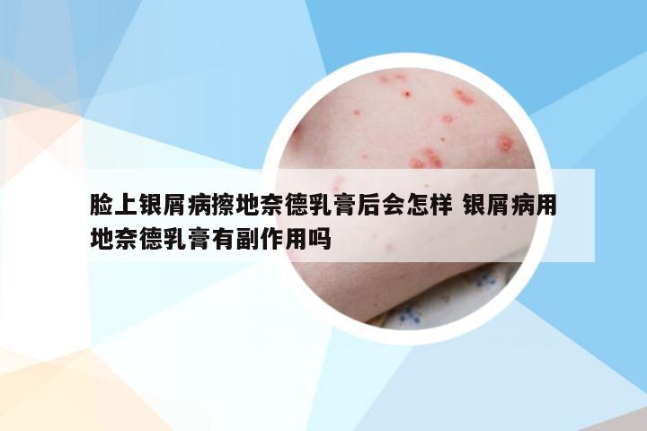 脸上银屑病擦地奈德乳膏后会怎样 银屑病用地奈德乳膏有副作用吗