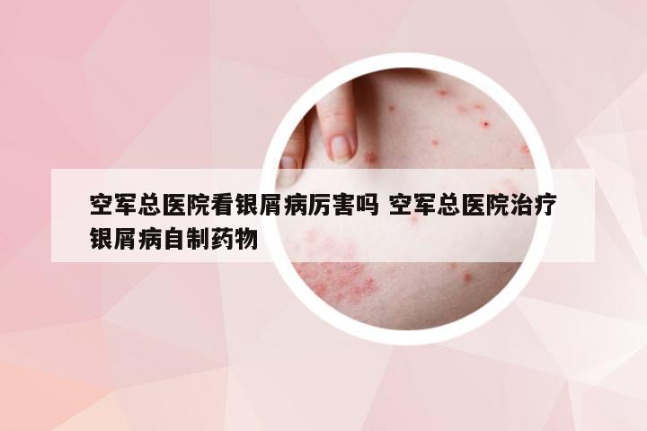 空军总医院看银屑病厉害吗 空军总医院治疗银屑病自制药物
