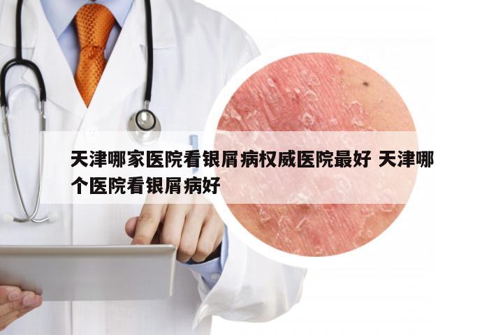 天津哪家医院看银屑病权威医院最好 天津哪个医院看银屑病好
