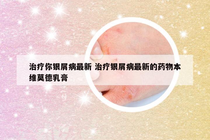 治疗你银屑病最新 治疗银屑病最新的药物本维莫德乳膏