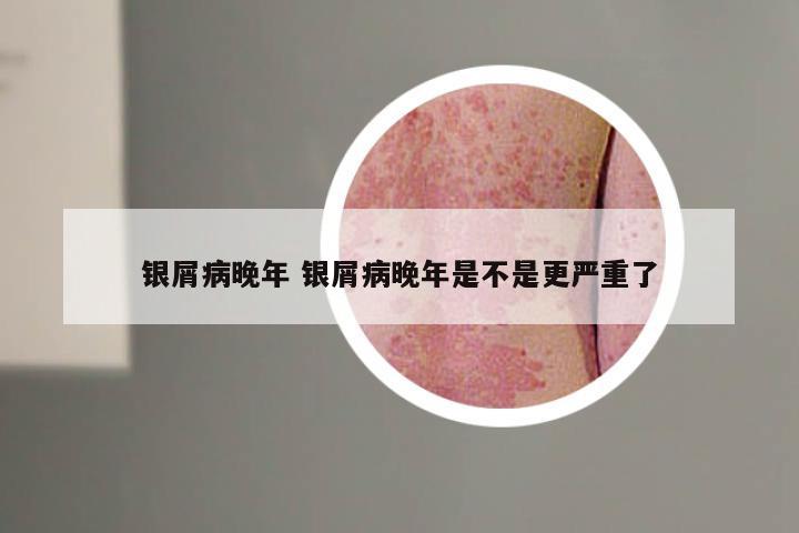 银屑病晚年 银屑病晚年是不是更严重了