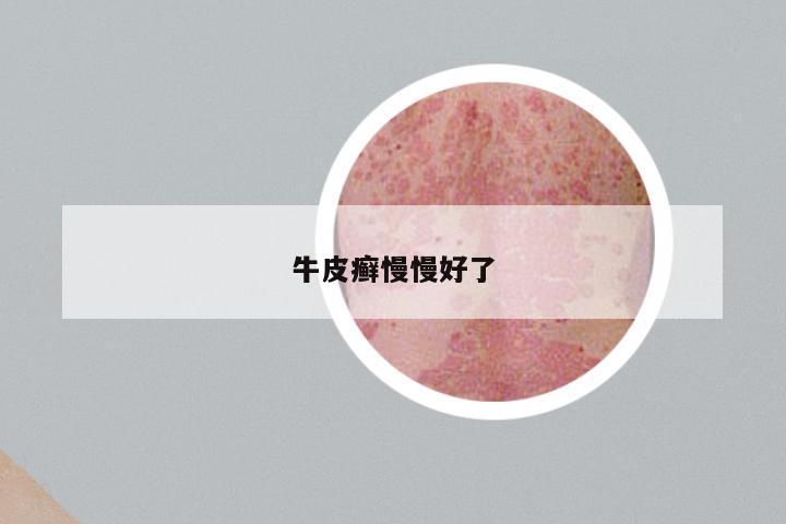 牛皮癣慢慢好了