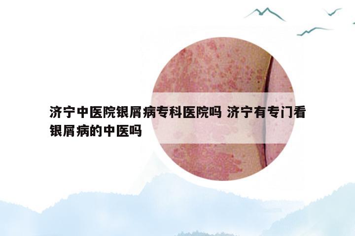 济宁中医院银屑病专科医院吗 济宁有专门看银屑病的中医吗