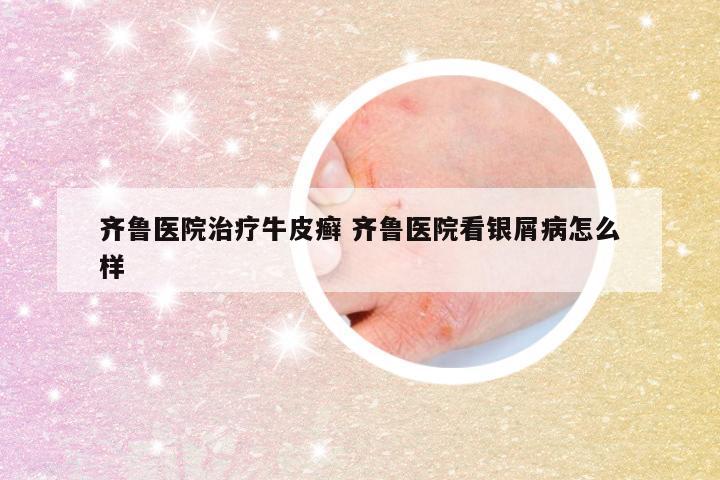 齐鲁医院治疗牛皮癣 齐鲁医院看银屑病怎么样