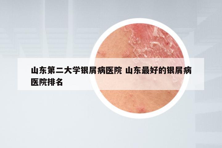 山东第二大学银屑病医院 山东最好的银屑病医院排名