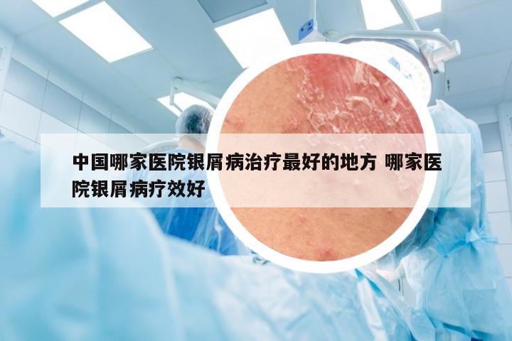 中国哪家医院银屑病治疗最好的地方 哪家医院银屑病疗效好