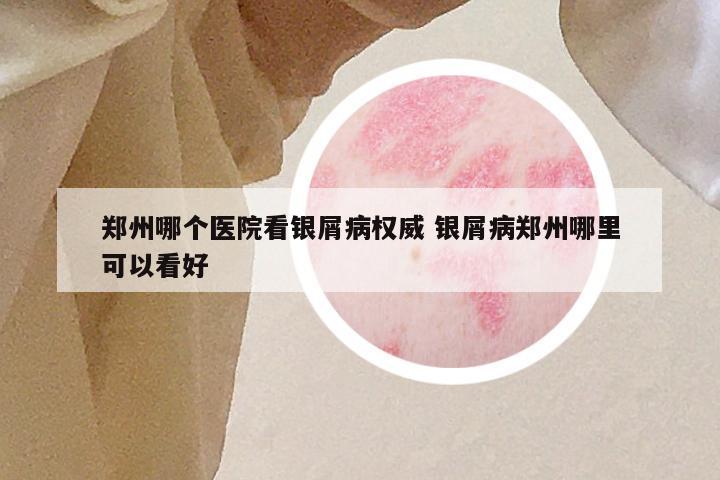 郑州哪个医院看银屑病权威 银屑病郑州哪里可以看好