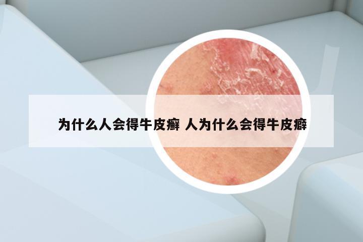为什么人会得牛皮癣 人为什么会得牛皮癖