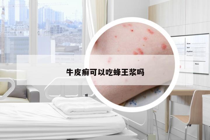 牛皮癣可以吃蜂王浆吗