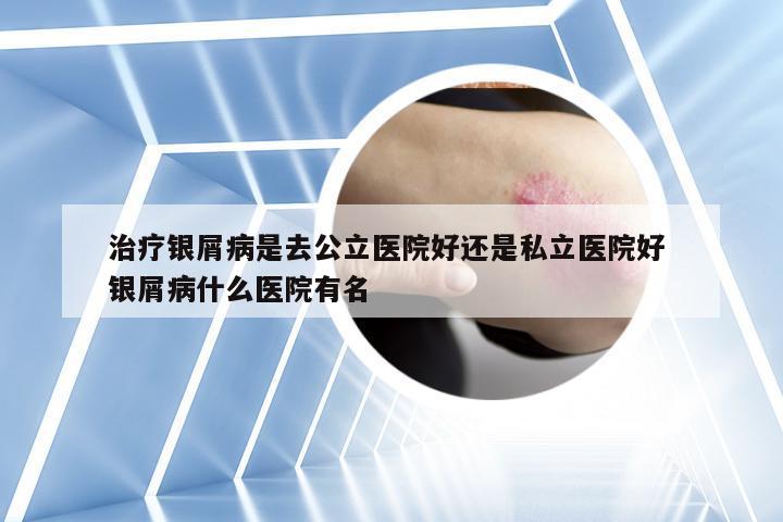 治疗银屑病是去公立医院好还是私立医院好 银屑病什么医院有名