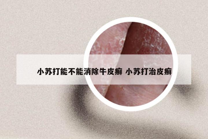 小苏打能不能消除牛皮癣 小苏打治皮癣