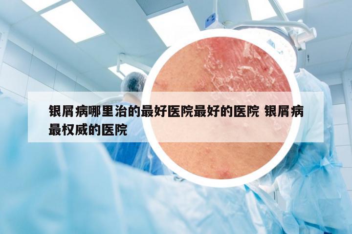 银屑病哪里治的最好医院最好的医院 银屑病最权威的医院