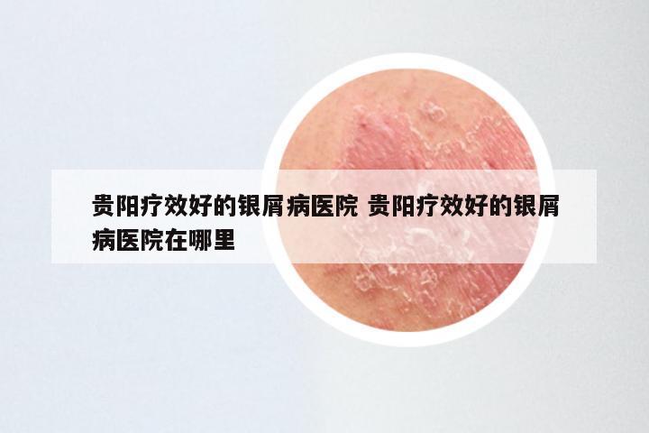 贵阳疗效好的银屑病医院 贵阳疗效好的银屑病医院在哪里