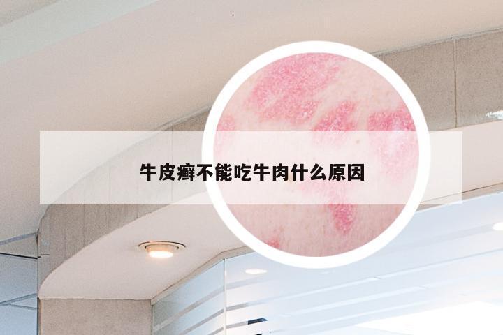 牛皮癣不能吃牛肉什么原因