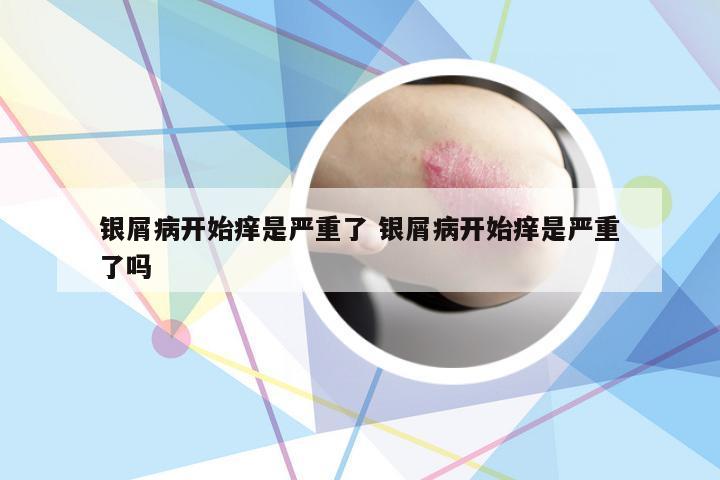 银屑病开始痒是严重了 银屑病开始痒是严重了吗