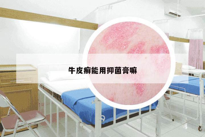 牛皮癣能用抑菌膏嘛