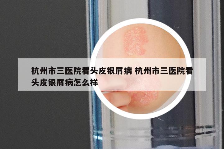 杭州市三医院看头皮银屑病 杭州市三医院看头皮银屑病怎么样