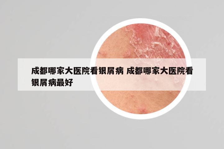 成都哪家大医院看银屑病 成都哪家大医院看银屑病最好
