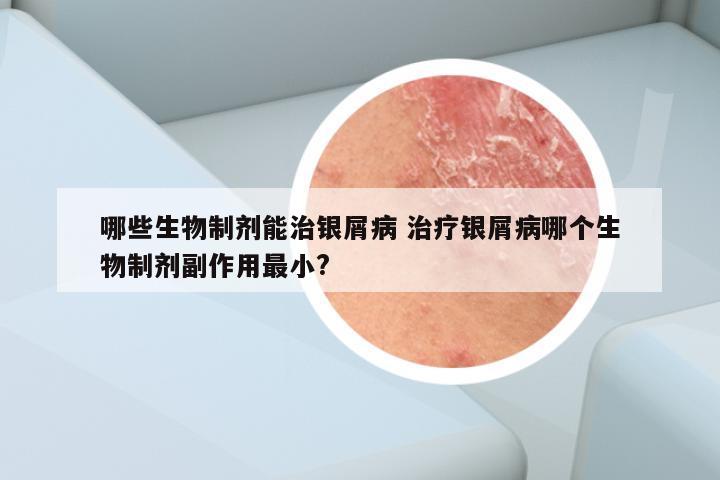 哪些生物制剂能治银屑病 治疗银屑病哪个生物制剂副作用最小?
