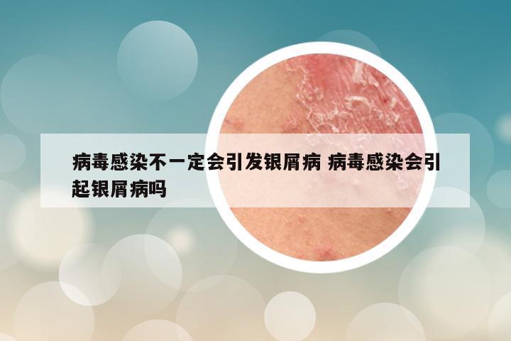 病毒感染不一定会引发银屑病 病毒感染会引起银屑病吗