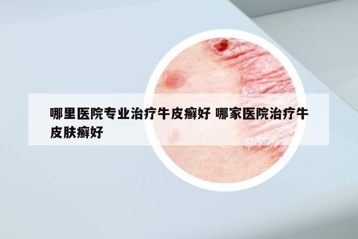 哪里医院专业治疗牛皮癣好 哪家医院治疗牛皮肤癣好