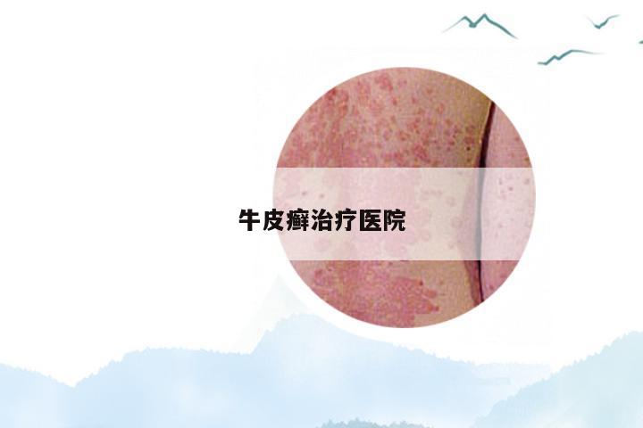 牛皮癣治疗医院