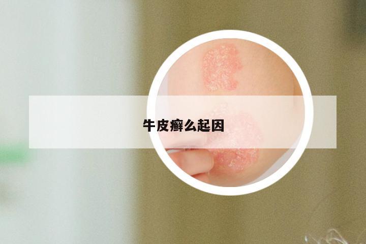 牛皮癣么起因