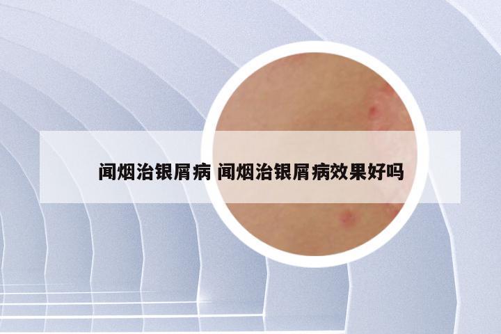闻烟治银屑病 闻烟治银屑病效果好吗