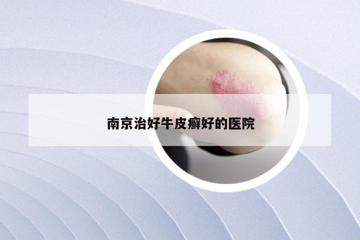南京治好牛皮癣好的医院