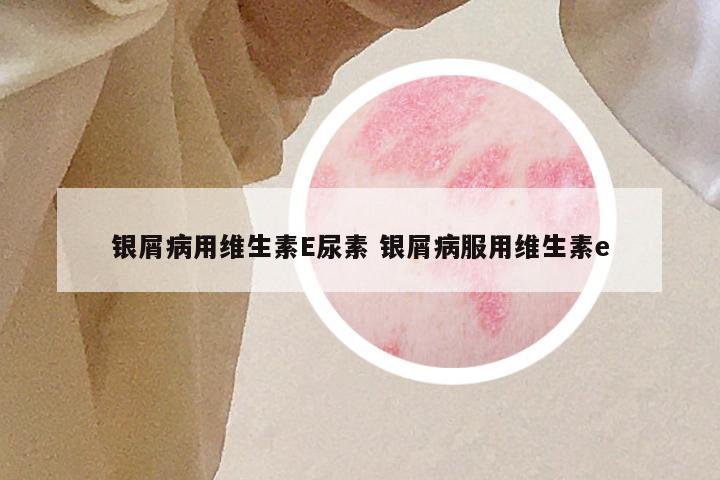 银屑病用维生素E尿素 银屑病服用维生素e